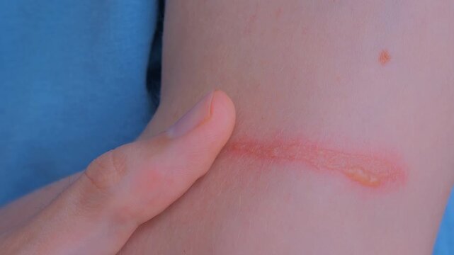 Close up view: man is showing burn mark, blister from burn on his arm, hand