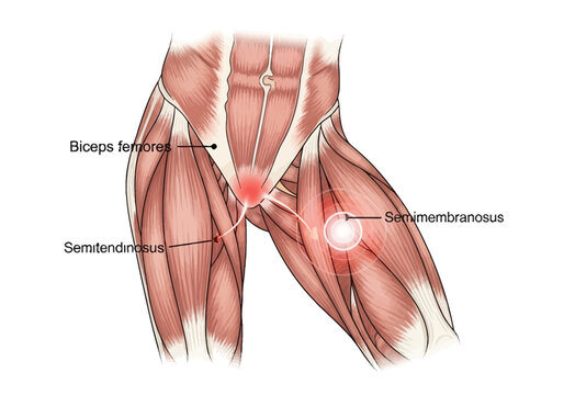 Anatomical medical illustration showing human hamstring muscle anatomy and injury locations for biceps femoris, semitendinosus, and semimembranosus muscles with red pain indicators.