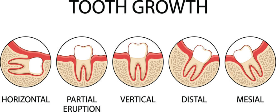 Tooth growth and wisdom teeth impaction types vector infographic diagram showing horizontal partial eruption vertical distal and mesial stages isolated on white background