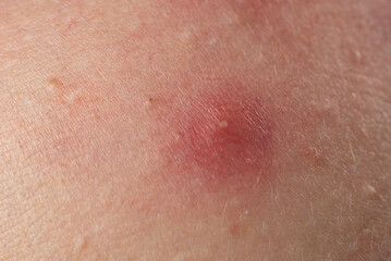 Fototapeta premium Skin problem background with infected bumps and acne. Inflamed skin bumps acne macro. Close up acne on skin. Irritated acne skin.