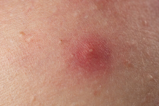 Skin problem background with infected bumps and acne. Inflamed skin bumps acne macro. Close up acne on skin. Irritated acne skin.