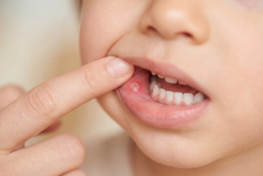 Close up of a small canker sore on a child mouth mucosa