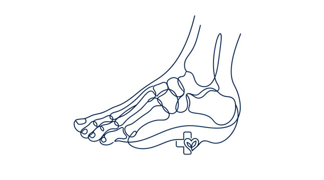 Ankle bone with metal surgical implant.