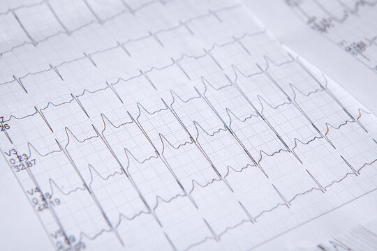 Electrocardiogram (ECG) on a white background