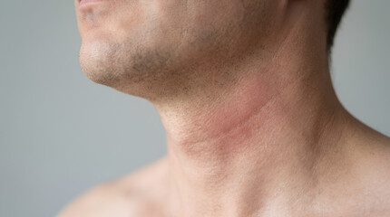 Naklejka premium Closeup of a mans neck with a red, irritated skin rash or allergic reaction