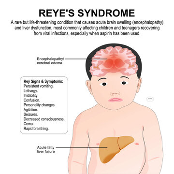 Reye's Syndrome Illustration