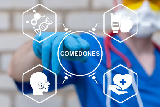 Medical concept of comedones treatment. Whiteheads, closed comedone, acne skin disease.
