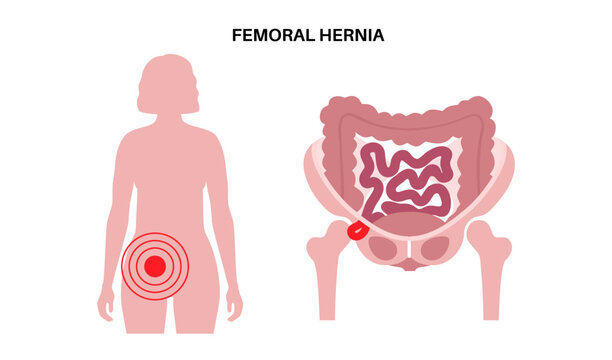 Abdominal Hernia poster