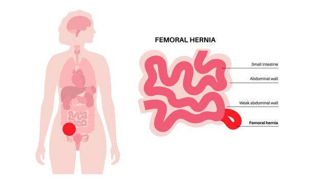 Abdominal Hernia poster