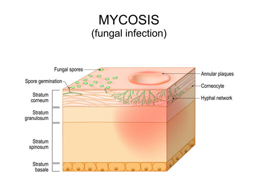 Skin Fungal infection. Mycosis. Skin disease caused by fungi. Dermatophyte, hyphae and spore invasion skin layer. Dermatology.