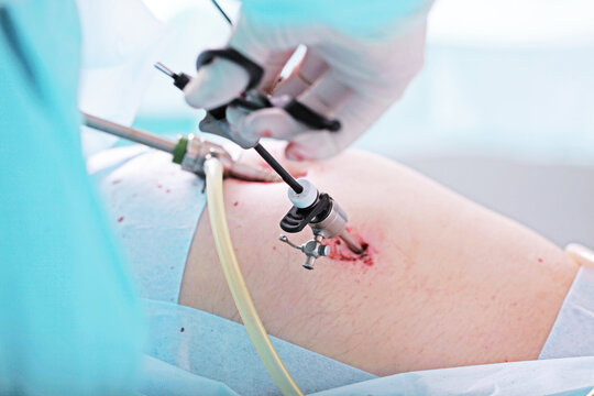 Laparoscopy in surgery. Surgery in abdominal cavity through small holes. Surgical team. Laparoscopic instruments. Hands in protective gloves