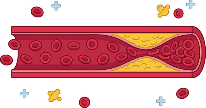 Atherosclerosis Medical Illustration showing Artery Blood Vessel Cross Section Blocked by Cholesterol Plaque Buildup Constricting Red Blood Cell Flow Graphic