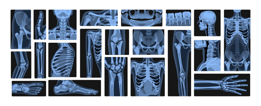 Set of human body x rays. Xrays of skeleton, spine, skull, wrist, arms and legs. Roentgen shots of fractures, bones and joints. Radiography and radiology in hospital. Flat vector illustrations