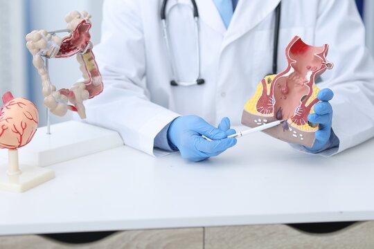Doctor showing model of unhealthy lower rectum in clinic, closeup