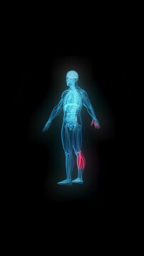 4k Resolution Vertical Video for Social Media: Transparent Human Skeleton With Animate Glowing Red Illness Zones Highlighting Internal Inflammation On Black 