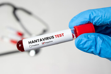 Obraz premium Negative Hantavirus Test Result in Blood Sample Tube