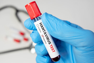 Obraz premium Negative Hantavirus Test Result with Medical Equipment Concept