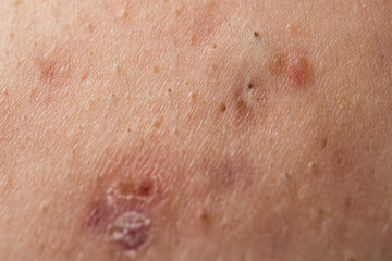 Fototapeta premium Pimple on inflamed body acne. Pimple with red skin irritation. Pimple near visible pores. Pimple in medical macro detail.
