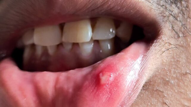 Closeup of a man showing a painful mouth ulcer or canker sore on the inner side of his lower lip