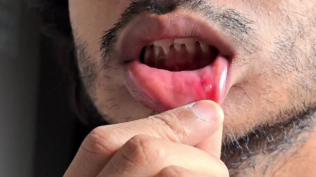Closeup of a man showing a painful mouth ulcer or canker sore on the inner side of his lower lip