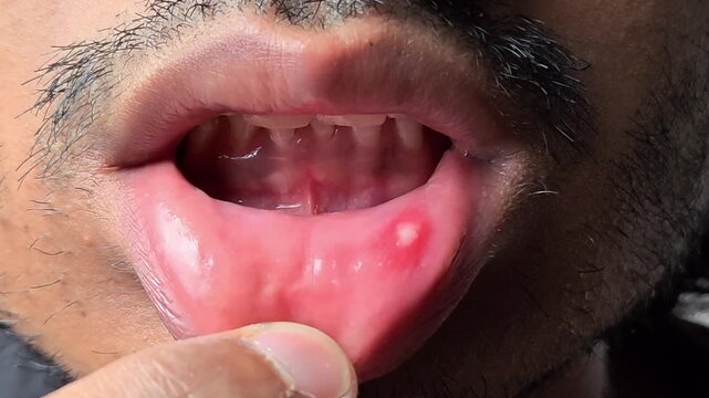 Closeup of a man showing a painful mouth ulcer or canker sore on the inner side of his lower lip