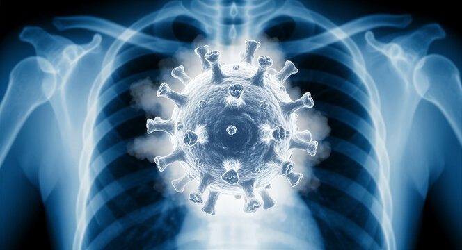 Virus particle superimposed on a human chest X-ray. Digital illustration showing the effect of respiratory infections on the lungs. Viral pneumonia concept for healthcare and medical diagnostics.