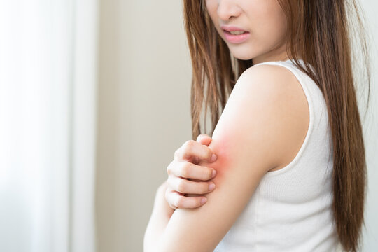 Dermatology asian young woman, girl allergy, allergic reaction from atopic, insect bites on arm, hand in scratching itchy, itch red spot or rash of skin. Healthcare, treatment of beauty on background.