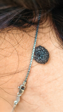Close-up view of a raised, dark mole on a person's neck near a silver necklace chain