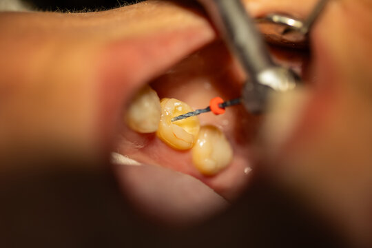 Dentist Performing Root Canal Treatment with Endodontic File