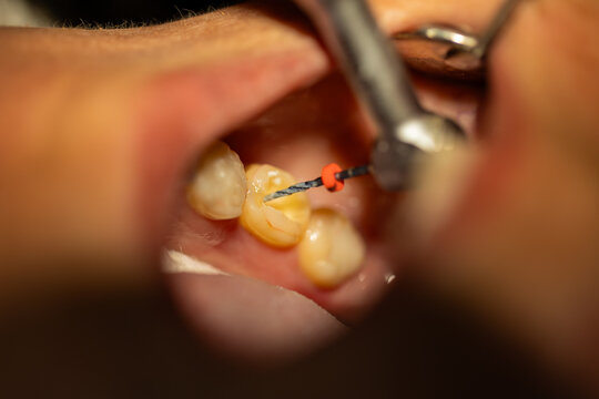 Dentist Performing Root Canal Procedure with Endodontic File
