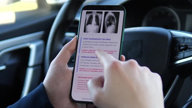 Viewing a Patient Dashboard with chest radiography results on a smartphone. The screen displays findings of rib fractures and a compression fracture. Perfect for telemedicine, trauma diagnostics, and