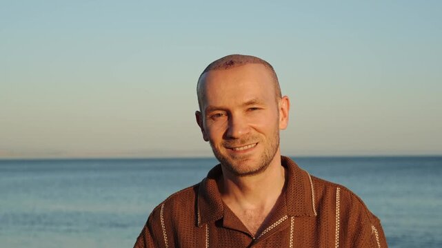 Portrait of a very happy, cheerfully smiling Caucasian man in a brown polo shirt displaying his healing scalp with scabs after a recent hair transplant procedure against the sunset ocean