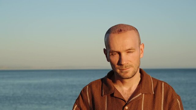 A portrait of a calm and serious Caucasian man in a brown polo shirt, showing a healing scalp with visible scabs after a recent hair transplant procedure, standing against the sunset ocean