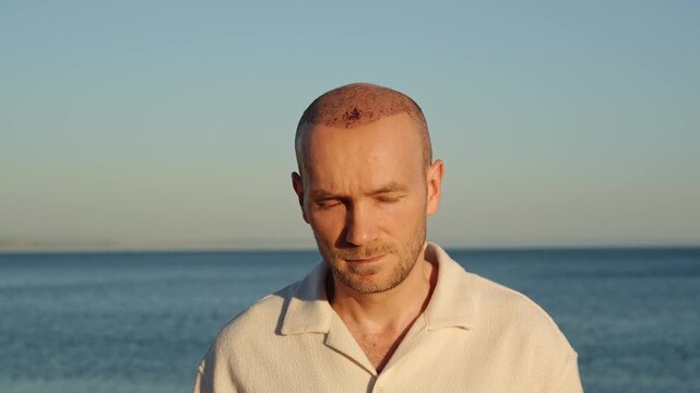 A portrait of a calm and slightly serious Caucasian man displaying healing scabs on his scalp after a recent hair transplant procedure, standing outdoors against the ocean at sunset