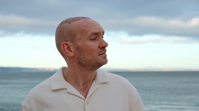 A frontal portrait of a calm Caucasian man with a subtle, neutral expression showing healing scabs on his scalp after a hair transplant operation, standing outdoors by the sea