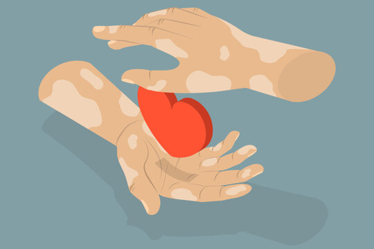 3D Isometric Flat Vector Illustration of Vitiligo, Leprosy-Affected Hands Supporting Heart Symbolize Care And Compassion.