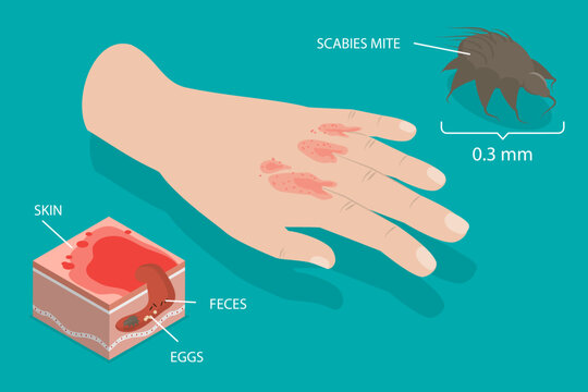 3D Isometric Flat Vector Illustration of Scabies, Scabies-Causing Parasite