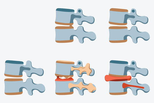 Illustration shows multiple stages of spinal disc degeneration and herniation affecting the vertebrae and surrounding nerves.