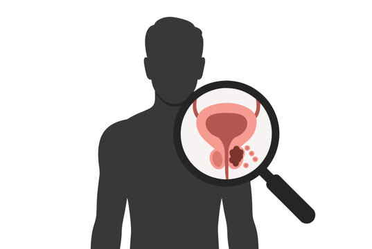 Silhouette of a man with a magnifying glass showing a cancerous tumor on the prostate gland for medical awareness.