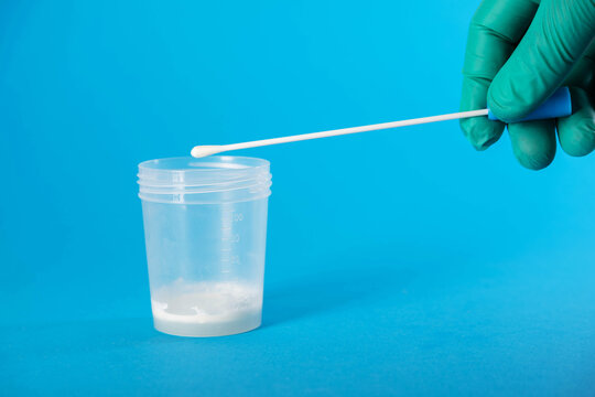 A laboratory technician's hand holds a medical swab against a background of ejaculate containing prostate fluid. Conceptual illustration of tests for sexually transmitted infections, chlamydia