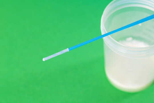 A urethral swab and ejaculate sample are taken to check for inflammation and infections in the reproductive organs. Inflammation, prostatitis, and urethritis are suspected due 