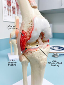 Medical model of knee joint inflammation, synovium, and joint effusion.