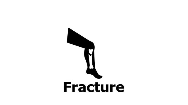 Animated by fracture of tibia,fibula bone icon.Bone break icon animation.