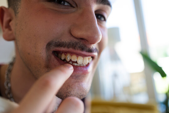 Young man smiling showing tooth gem on tooth
