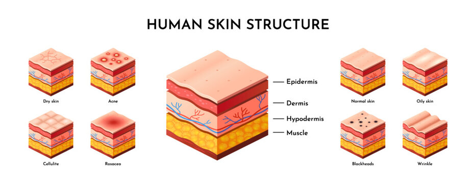 Medical vector diagram of human skin structure with labeled layers, epidermis, dermis, hypodermis and skin condition cross sections. Educational anatomy infographic for dermatology design