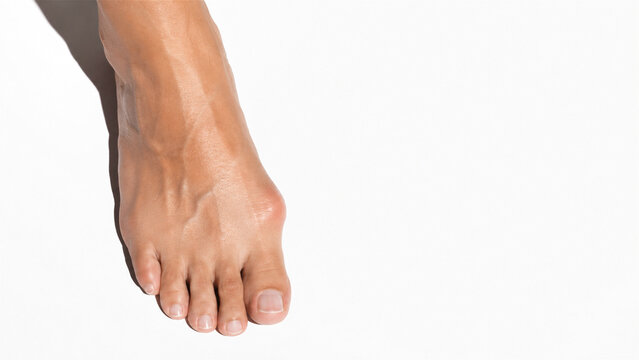 woman foot with bunion on white background. Close up of human hallux valgus deformity. Medical orthopaedic health condition, joint inflammation and toe problem, podiatry care concept