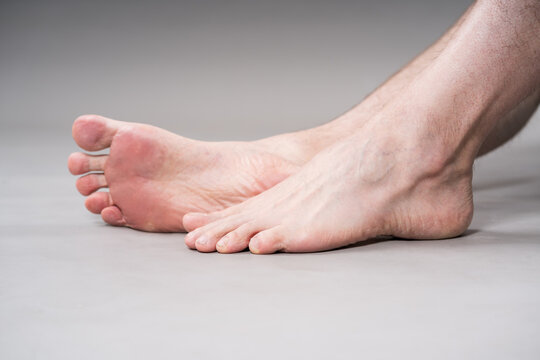 Close up of male bare foot sole showing dry skin, wrinkles and calluses. Concept of podiatry, dermatology or male pedicure