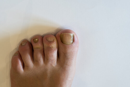 High angle close-up of a human foot resting on a clean white surface, showing multiple toenails affected by severe yellow and thick fungal infection.
