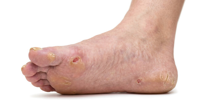 Diabetic foot ulcer and skin complications close-up. Chronic wound, neuropathy or peripheral artery disease medical concept. Isolated on white. AI generated.