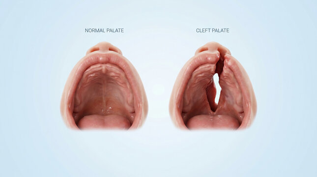 Cleft Palate Congenital Craniofacial Lip Mouth Malformation
